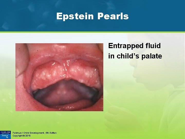 Epstein Pearls Entrapped fluid in child’s palate Feldman / Child Development, 5 th Edition