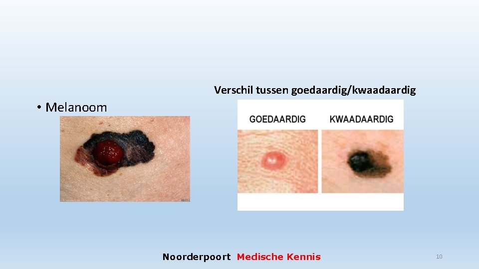 Gezwellen Benigne goedaardig Maligne kwaadaardig Lichaam opgebouwd uit