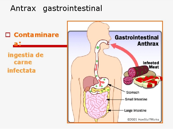 Antrax gastrointestinal o Contaminare a: ingestia de carne infectata 