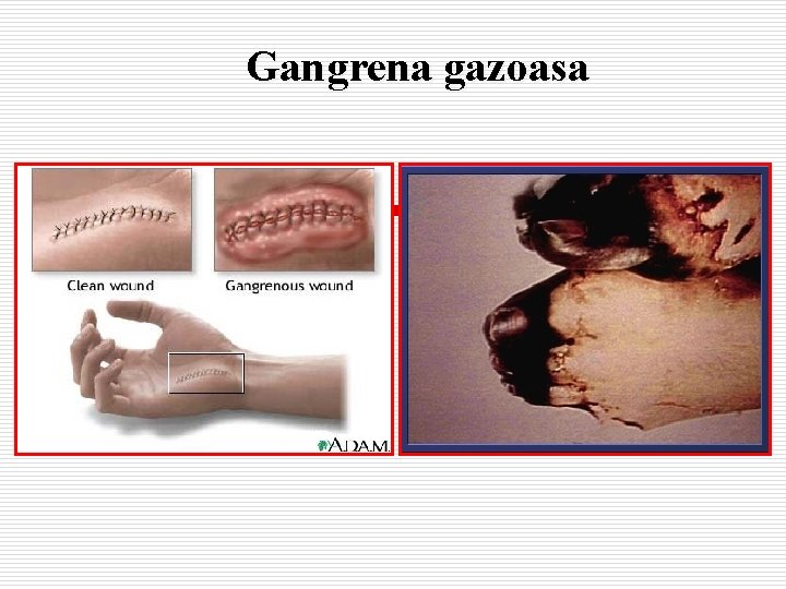 Gangrena gazoasa 