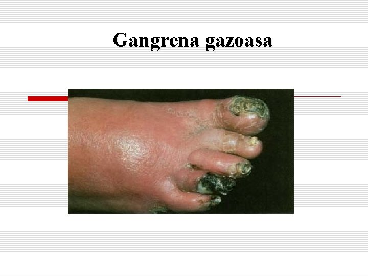 Gangrena gazoasa 