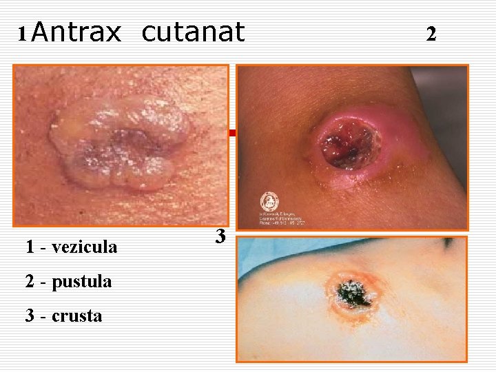 1 Antrax cutanat 1 - vezicula 2 - pustula 3 - crusta 3 2