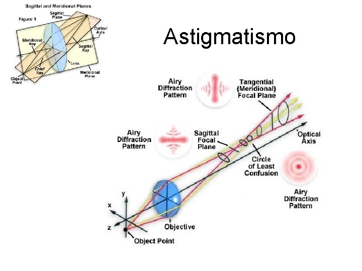 Astigmatismo 