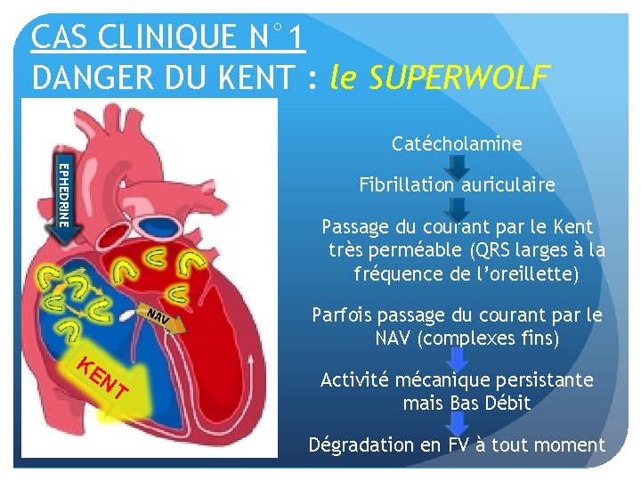 CAS CLINIQUE N° 1 DANGER DU KENT : le SUPERWOLF Catécholamine EPHEDRINE Fibrillation auriculaire