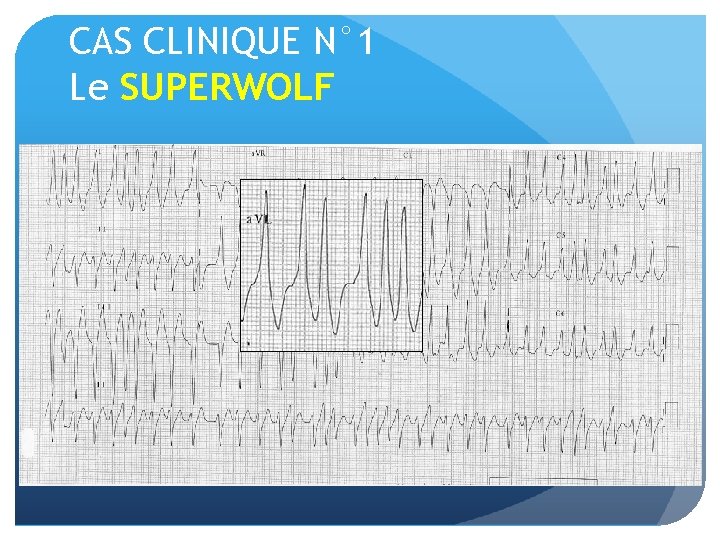 CAS CLINIQUE N° 1 Le SUPERWOLF En ACCORDEON, ECG CARACTERISTIQUE D’UN DECOMPENSATION DU KENT
