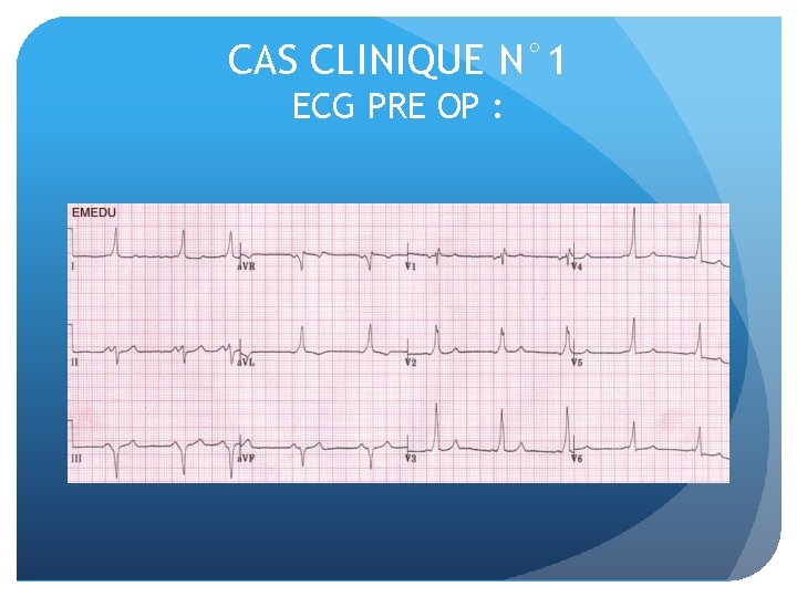 CAS CLINIQUE N° 1 ECG PRE OP : 