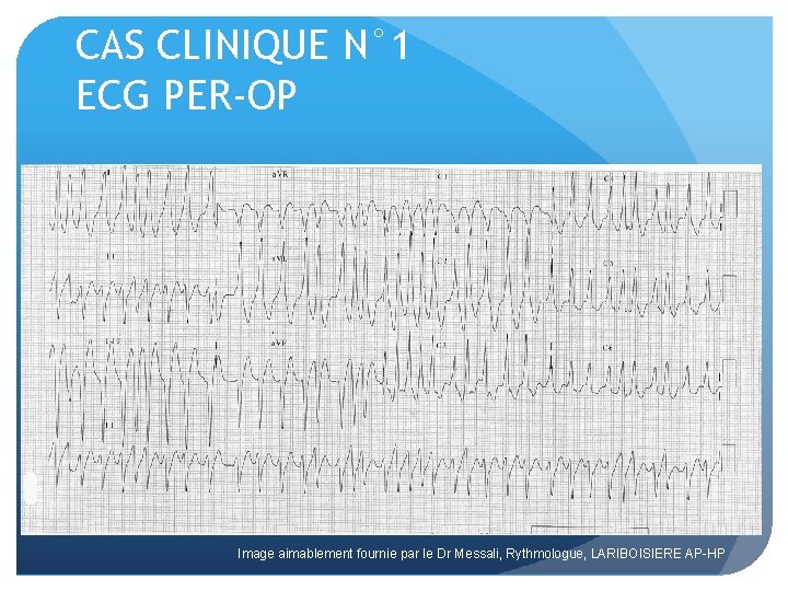 CAS CLINIQUE N° 1 ECG PER-OP Image aimablement fournie par le Dr Messali, Rythmologue,