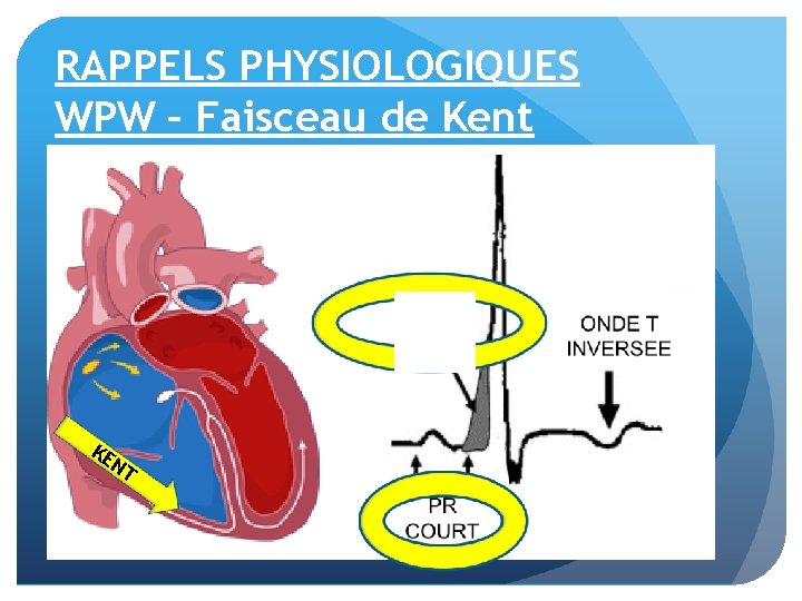 RAPPELS PHYSIOLOGIQUES WPW – Faisceau de Kent KE NT 