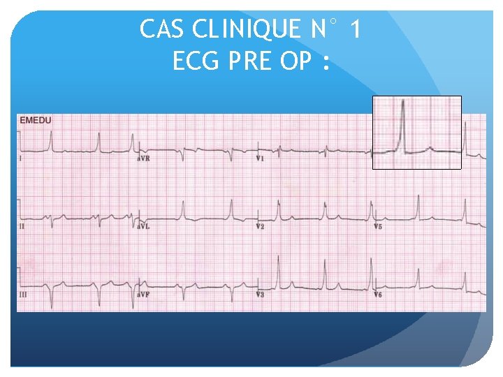 CAS CLINIQUE N° 1 ECG PRE OP : 