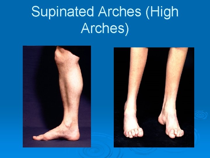 Supinated Arches (High Arches) 