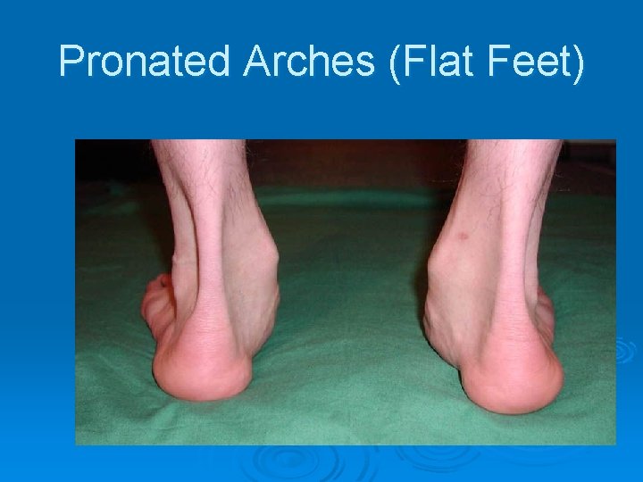 Pronated Arches (Flat Feet) 