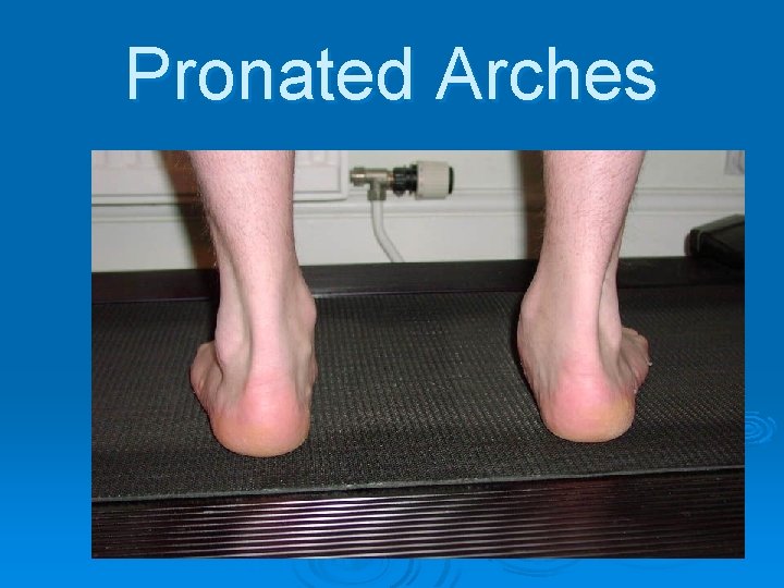 Pronated Arches 