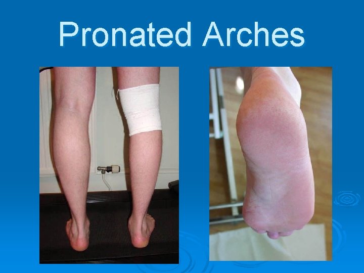 Pronated Arches 