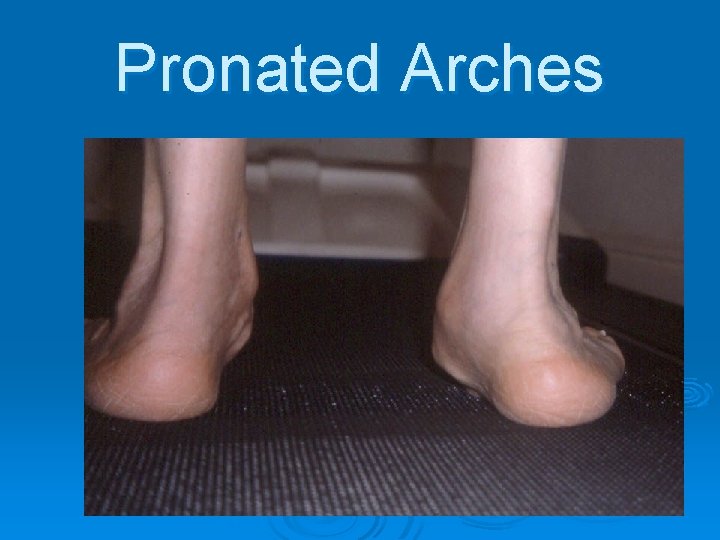 Pronated Arches 