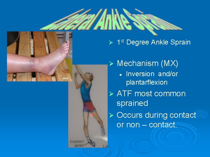 Ø 1 st Degree Ankle Sprain Ø Mechanism (MX) l Inversion and/or plantarflexion ATF