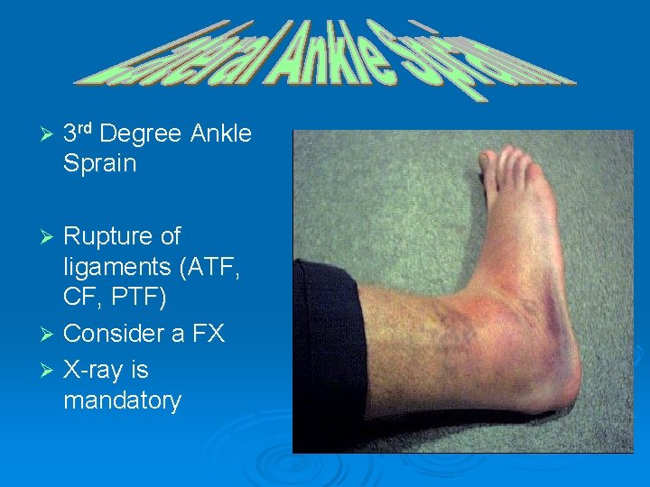 Ø 3 rd Degree Ankle Sprain Rupture of ligaments (ATF, CF, PTF) Ø Consider