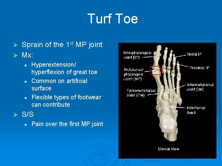 Turf Toe Sprain of the 1 st MP joint Ø Mx: Ø l l