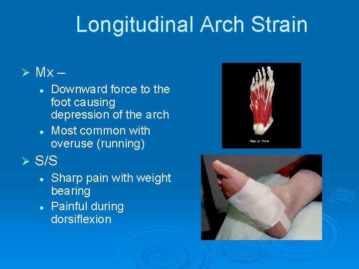 Longitudinal Arch Strain Ø Mx – l l Ø Downward force to the foot