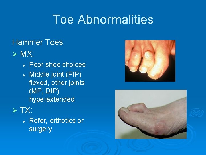 Toe Abnormalities Hammer Toes Ø MX: l l Ø Poor shoe choices Middle joint