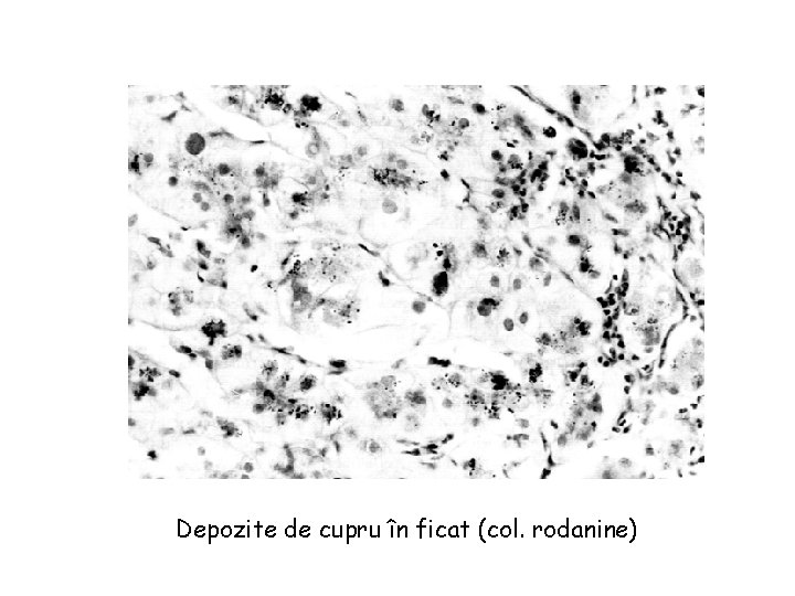 Depozite de cupru în ficat (col. rodanine) 