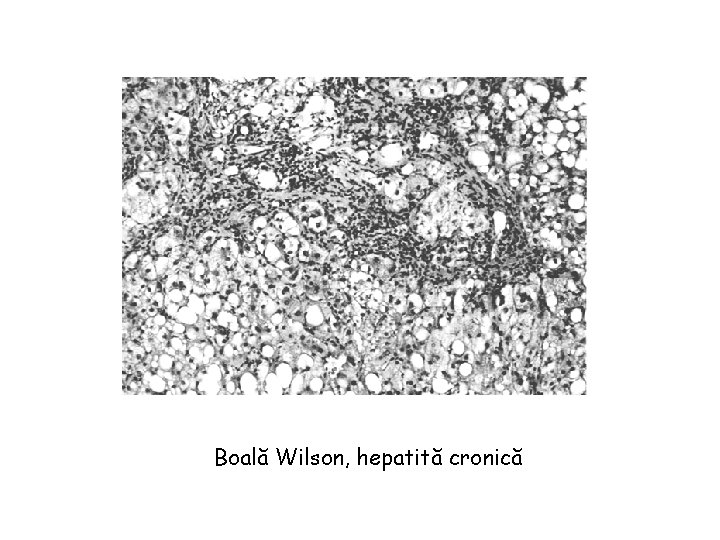 Boală Wilson, hepatită cronică 