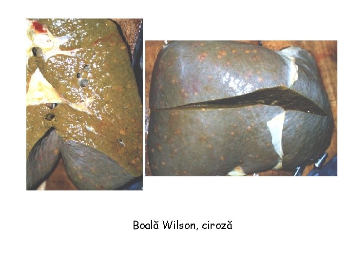 Boală Wilson, ciroză 