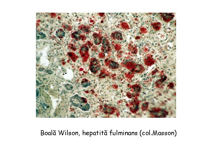 Boală Wilson, hepatită fulminans (col. Masson) 