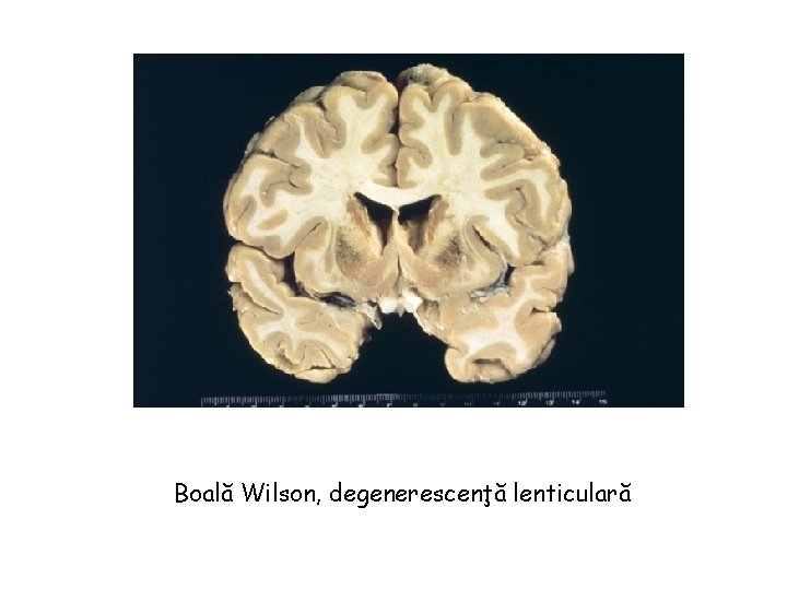 Boală Wilson, degenerescenţă lenticulară 