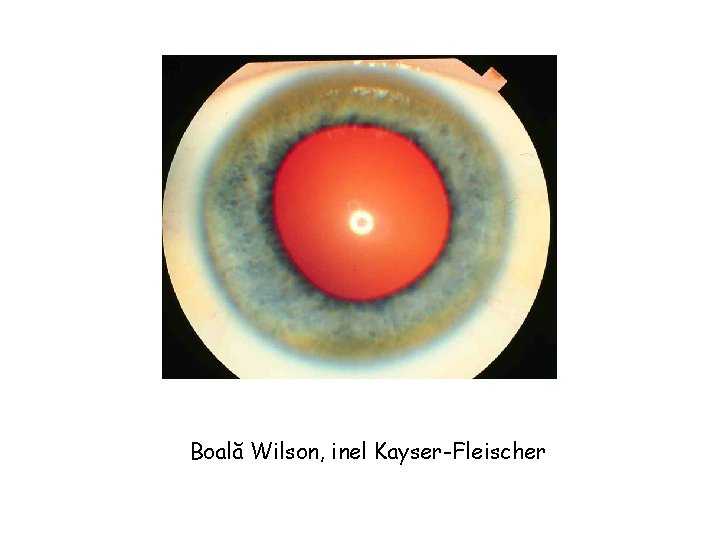 Boală Wilson, inel Kayser-Fleischer 