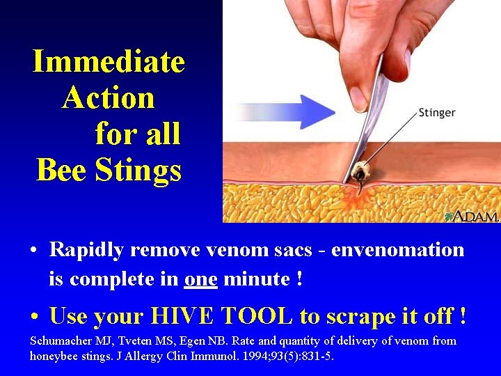 Immediate Action for all Bee Stings • Rapidly remove venom sacs - envenomation is