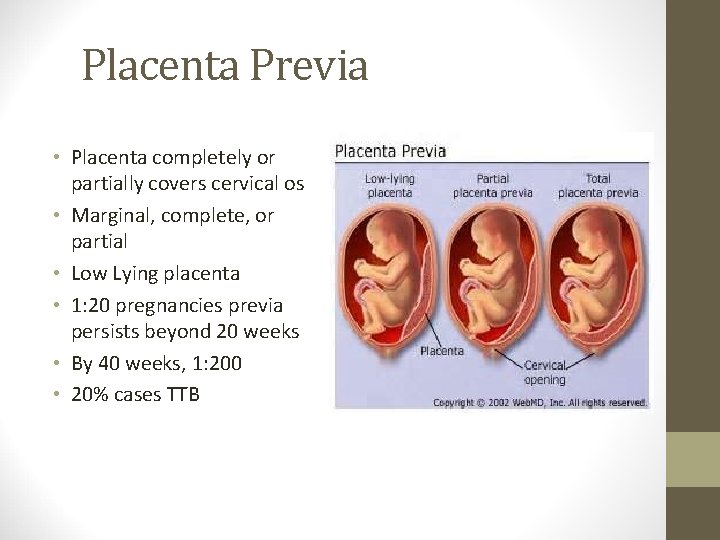 Placenta Previa • Placenta completely or partially covers cervical os • Marginal, complete, or