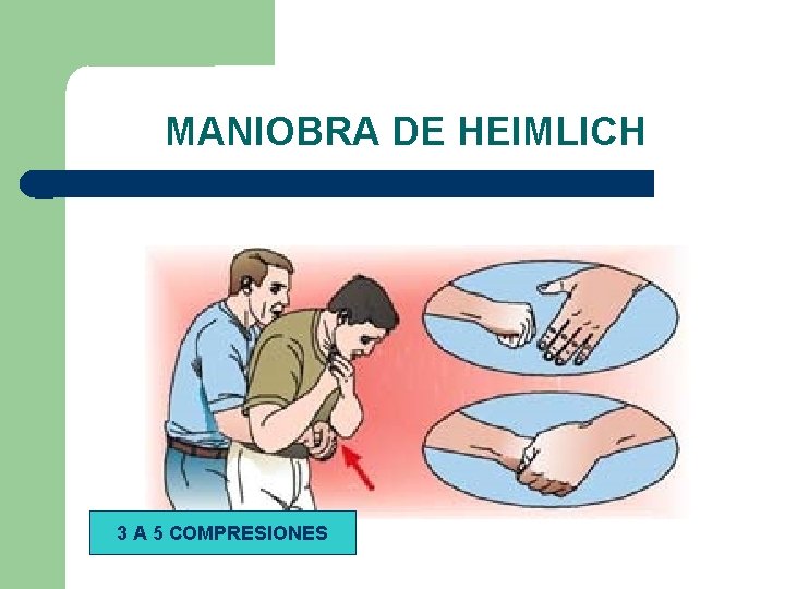 MANIOBRA DE HEIMLICH 3 A 5 COMPRESIONES 