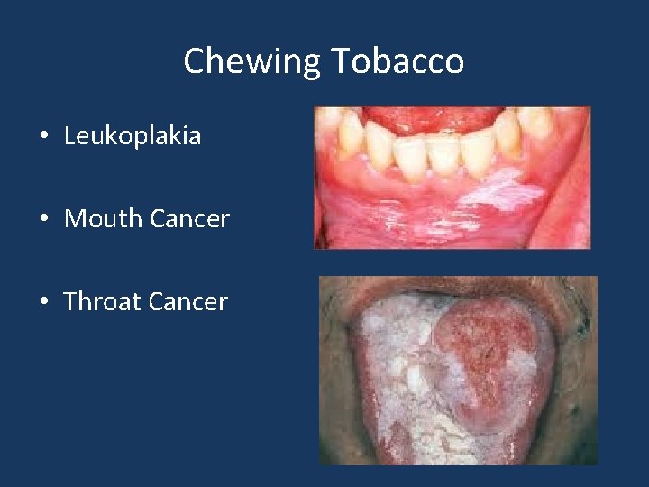 Chewing Tobacco • Leukoplakia • Mouth Cancer • Throat Cancer 