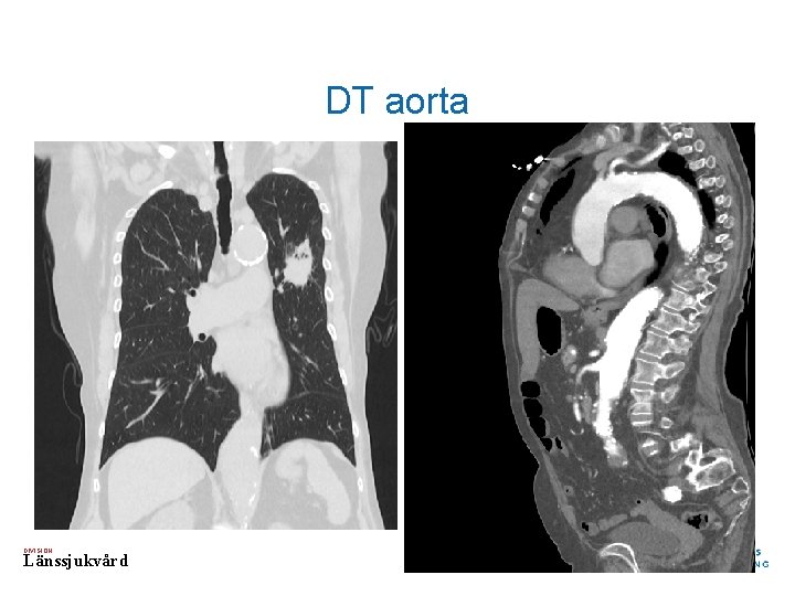 DT aorta DIVISION Länssjukvård 
