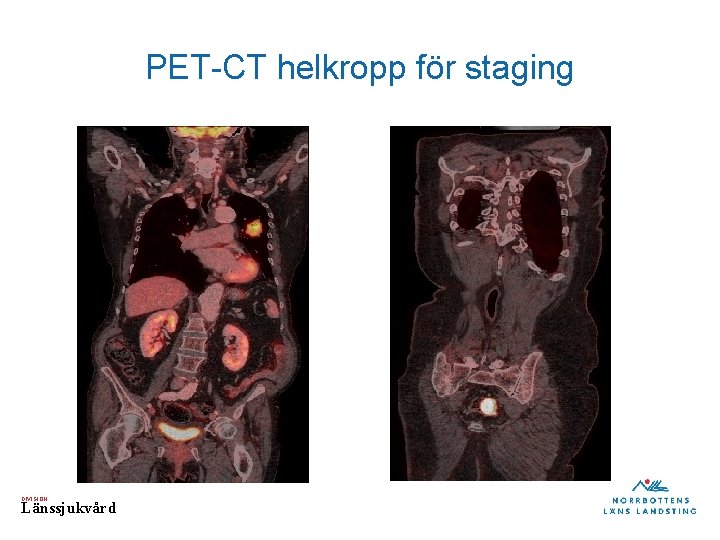 PET-CT helkropp för staging DIVISION Länssjukvård 