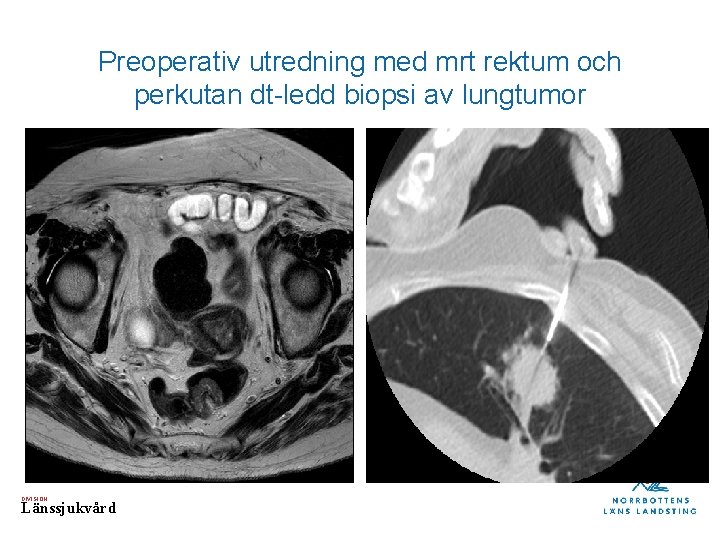 Preoperativ utredning med mrt rektum och perkutan dt-ledd biopsi av lungtumor DIVISION Länssjukvård 