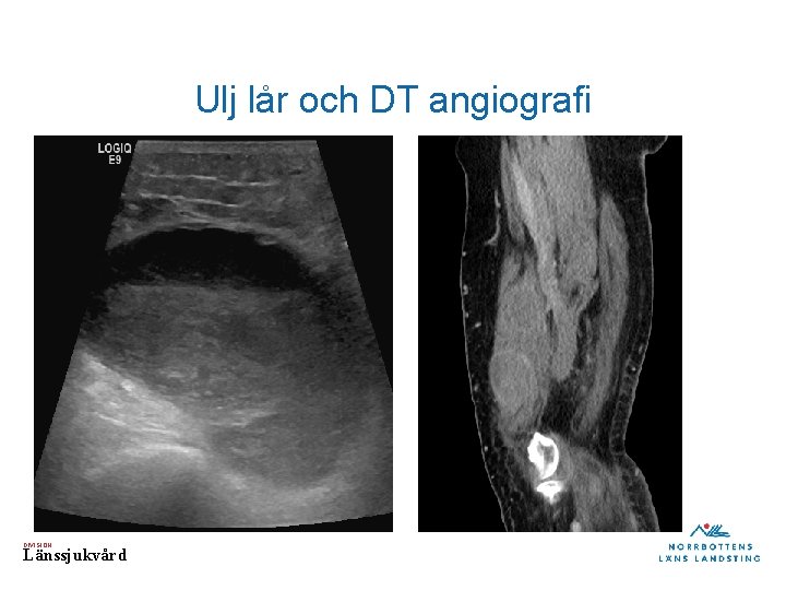 Ulj lår och DT angiografi DIVISION Länssjukvård 