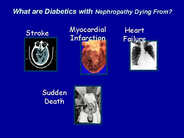 What are Diabetics with Nephropathy Dying From? Stroke Sudden Death Myocardial Infarction Heart Failure