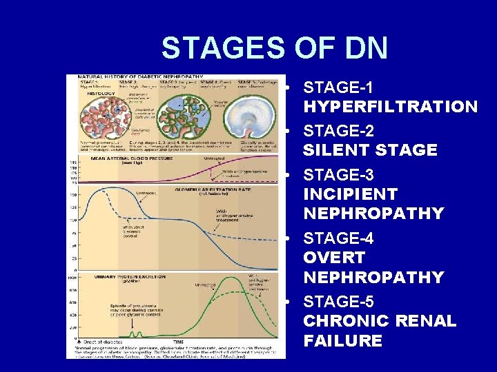 STAGES OF DN • STAGE-1 HYPERFILTRATION • STAGE-2 SILENT STAGE • STAGE-3 INCIPIENT NEPHROPATHY