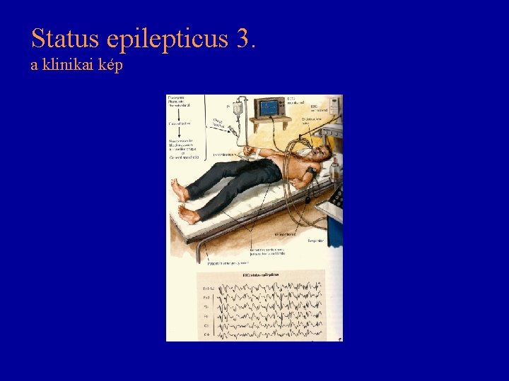 Status epilepticus 3. a klinikai kép Status epilepticus 3. a klinikai kép