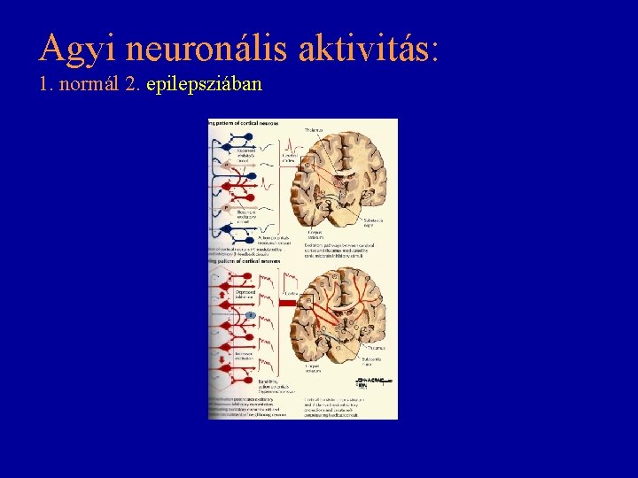 Agyi neuronális aktivitás: 1. normál 2. epilepsziában Agyi neuronális aktivitás: 1. normál 2. epilepsziában