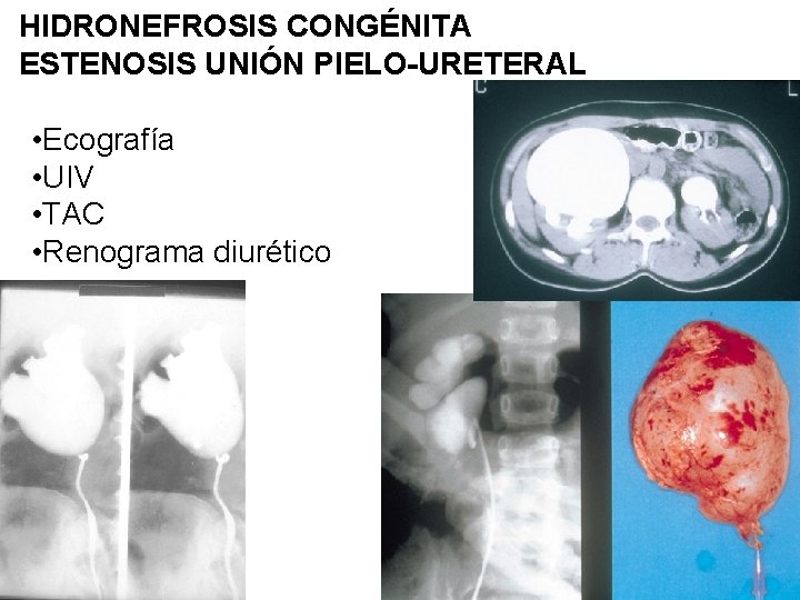HIDRONEFROSIS CONGÉNITA ESTENOSIS UNIÓN PIELO-URETERAL • Ecografía • UIV • TAC • Renograma diurético