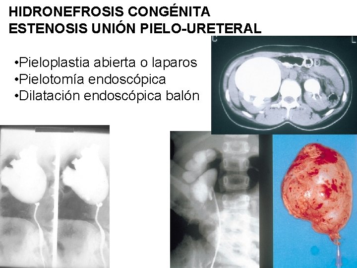 HIDRONEFROSIS CONGÉNITA ESTENOSIS UNIÓN PIELO-URETERAL • Pieloplastia abierta o laparos • Pielotomía endoscópica •