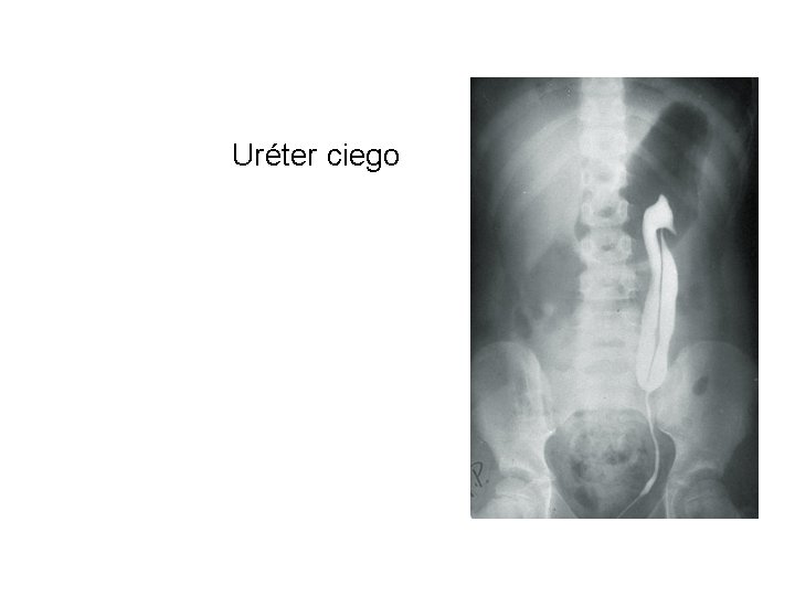 Uréter ciego 