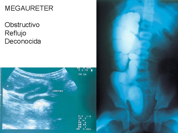 MEGAURETER Obstructivo Reflujo Deconocida 