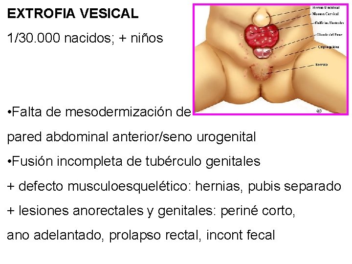 EXTROFIA VESICAL 1/30. 000 nacidos; + niños • Falta de mesodermización de pared abdominal