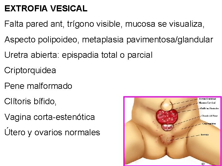 EXTROFIA VESICAL Falta pared ant, trígono visible, mucosa se visualiza, Aspecto polipoideo, metaplasia pavimentosa/glandular