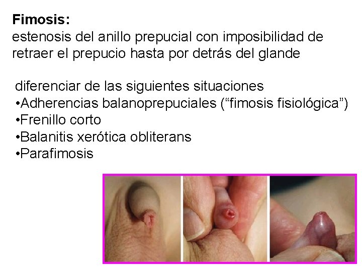 Fimosis: estenosis del anillo prepucial con imposibilidad de retraer el prepucio hasta por detrás