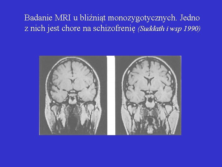 Badanie MRI u bliźniąt monozygotycznych. Jedno z nich jest chore na schizofrenię (Suddath i