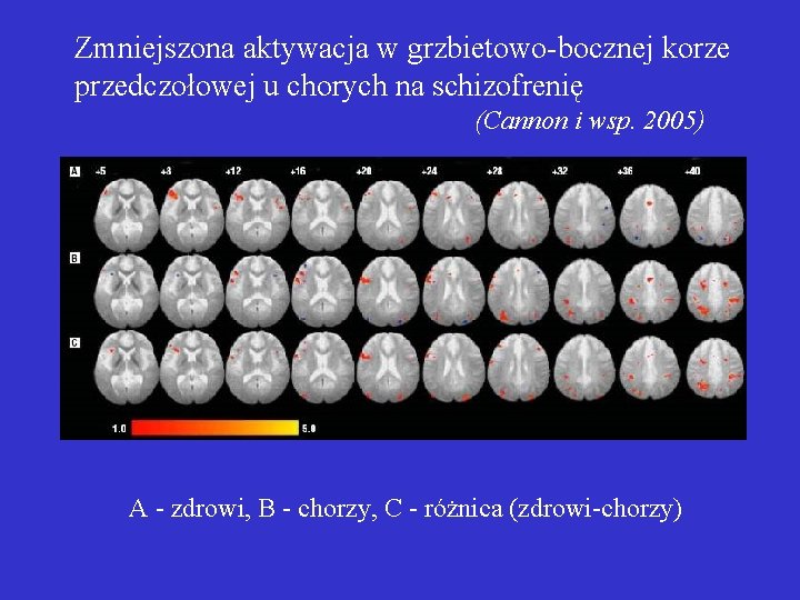 Zmniejszona aktywacja w grzbietowo-bocznej korze przedczołowej u chorych na schizofrenię (Cannon i wsp. 2005)